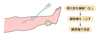 注射で治す硬化療法